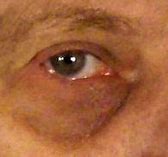 الهالات السوداء