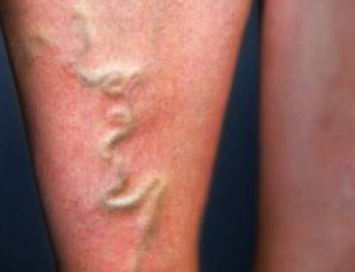 دوالي الحمل في الفخذ