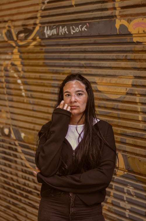 علاج البهاق