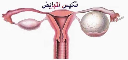 تكيس المبايض