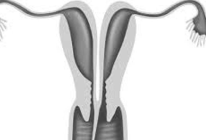 الرحم المقسوم