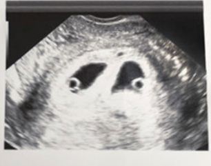 الحمل في توأم